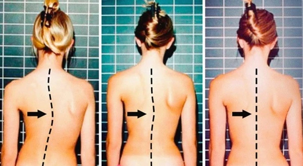 Vì sao thanh, thiếu niên dễ bị vẹo cột sống?