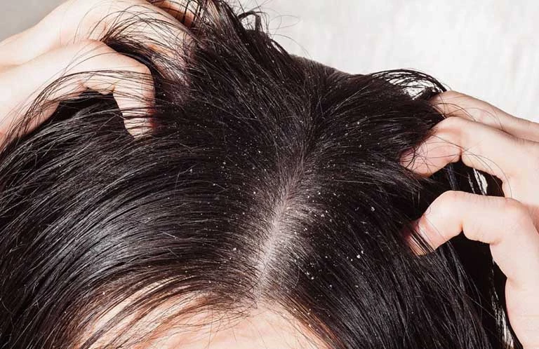 Vì sao một số người đầu có gầu nhiêu?