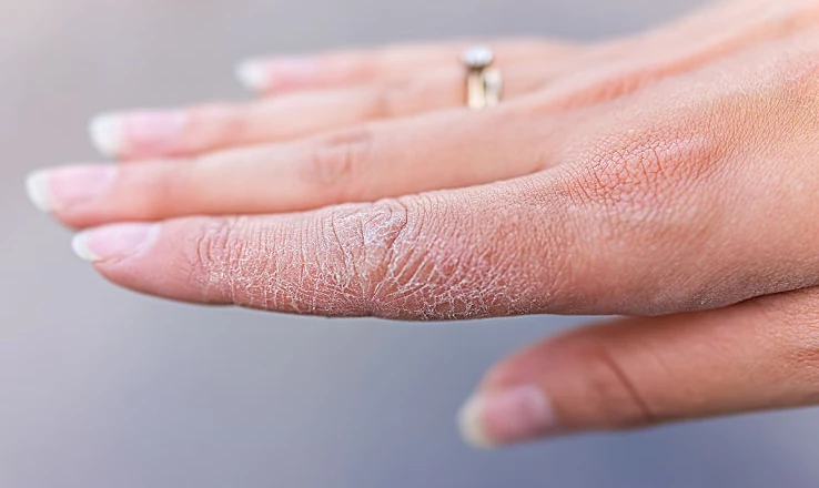 Vì sao vào mùa đông, vành tai và tay một số người hay bị nứt nẻ?