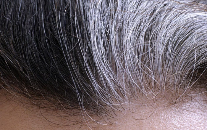 Vì sao tóc của một số thanh, thiếu niên bạc sớm?