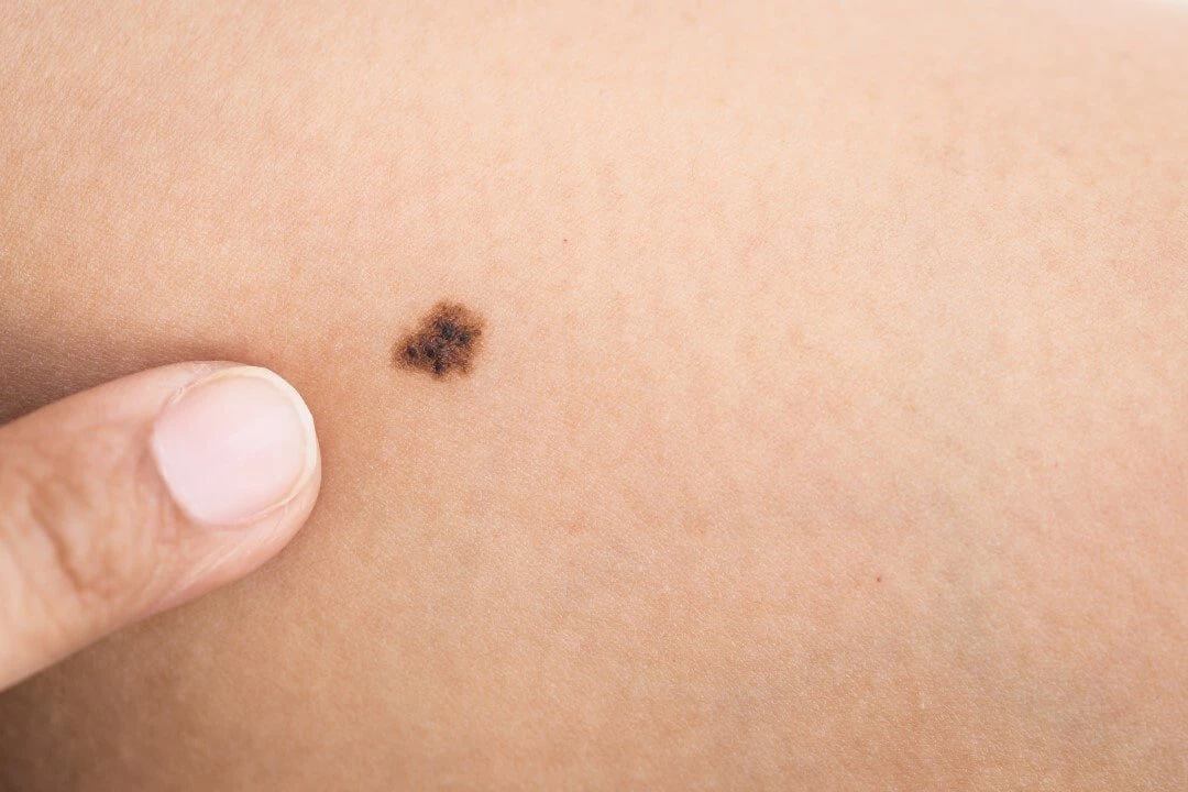 Vì sao có nốt ruồi?