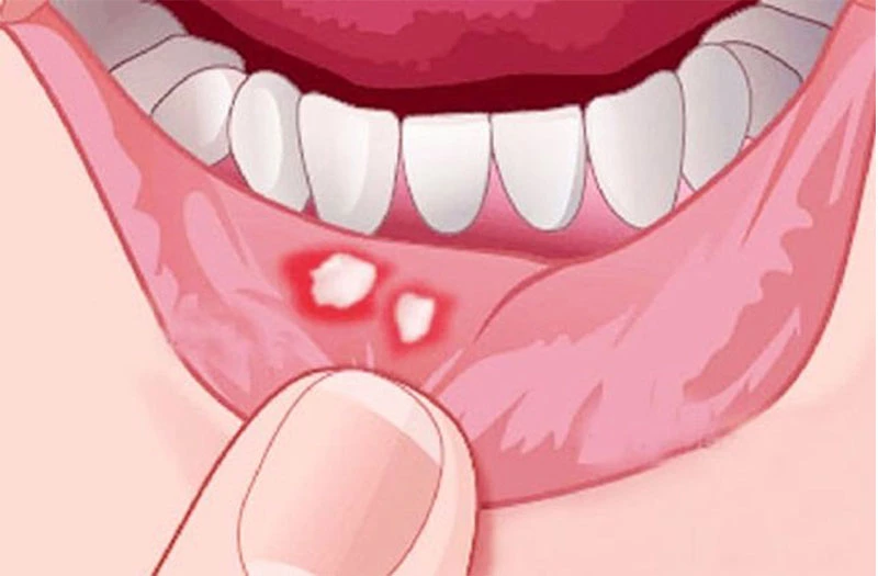 Vì sao miệng vết thương gặp phải chất mặn thì dễ xót?