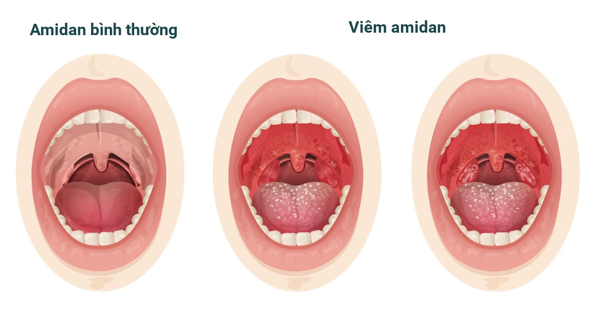 Amidan thường được bác sĩ cắt bỏ khỏi cơ thể bệnh nhân, phải chăng nó không có vai trò gì