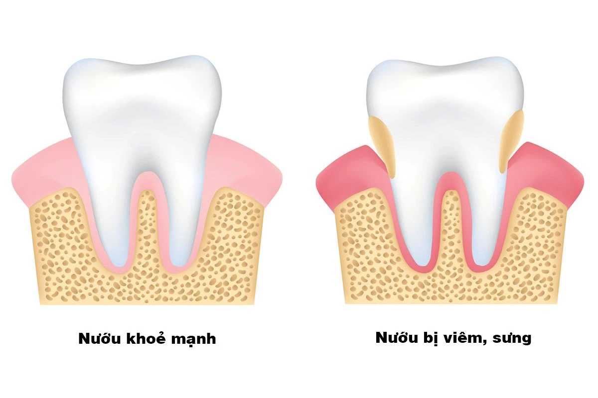 Vì sao bị sâu răng?